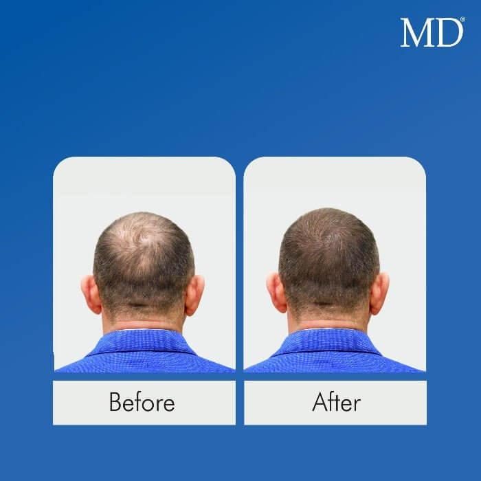 Before and after photo of male with balding at the crown showing visible hair regrowth and thicker hair after using MD Nutri Hair – drug-free hair growth supplement from MD Hair