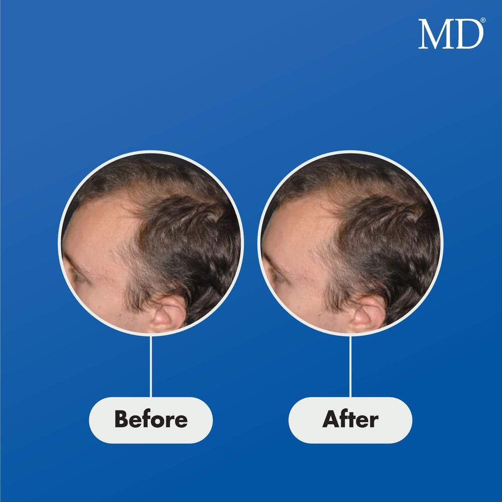 Before and after results of male using MD® Follicle Energizer – visible improvement in thinning hair and bald spot coverage with MD Hair serum


