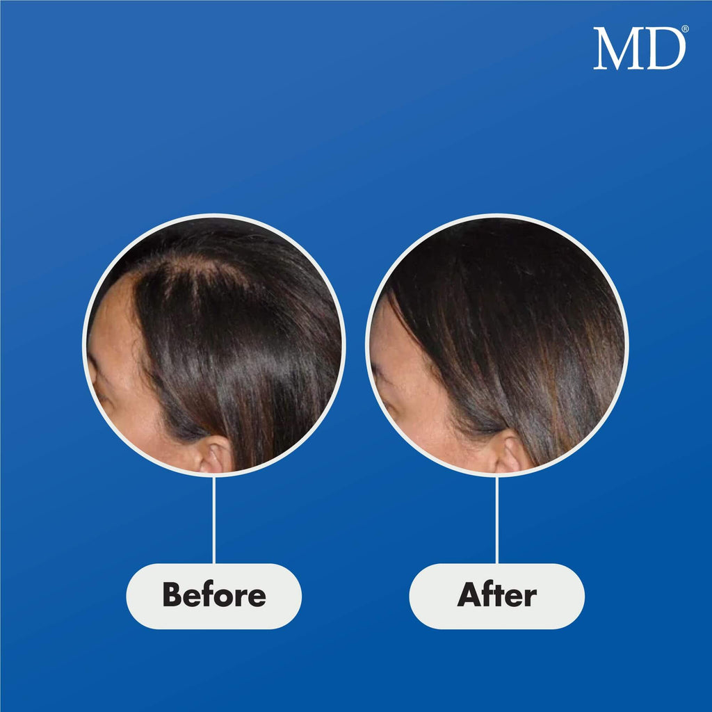 Female model before and after using MD Follicle Energizer showing visibly fuller hairline – MD Hair by MD