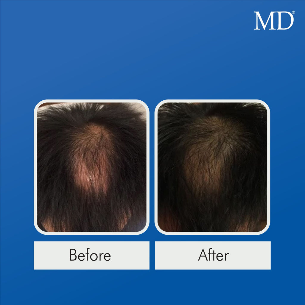 Male model before and after using MD Follicle Energizer showing filled-in crown bald spot – MD Hair by MD