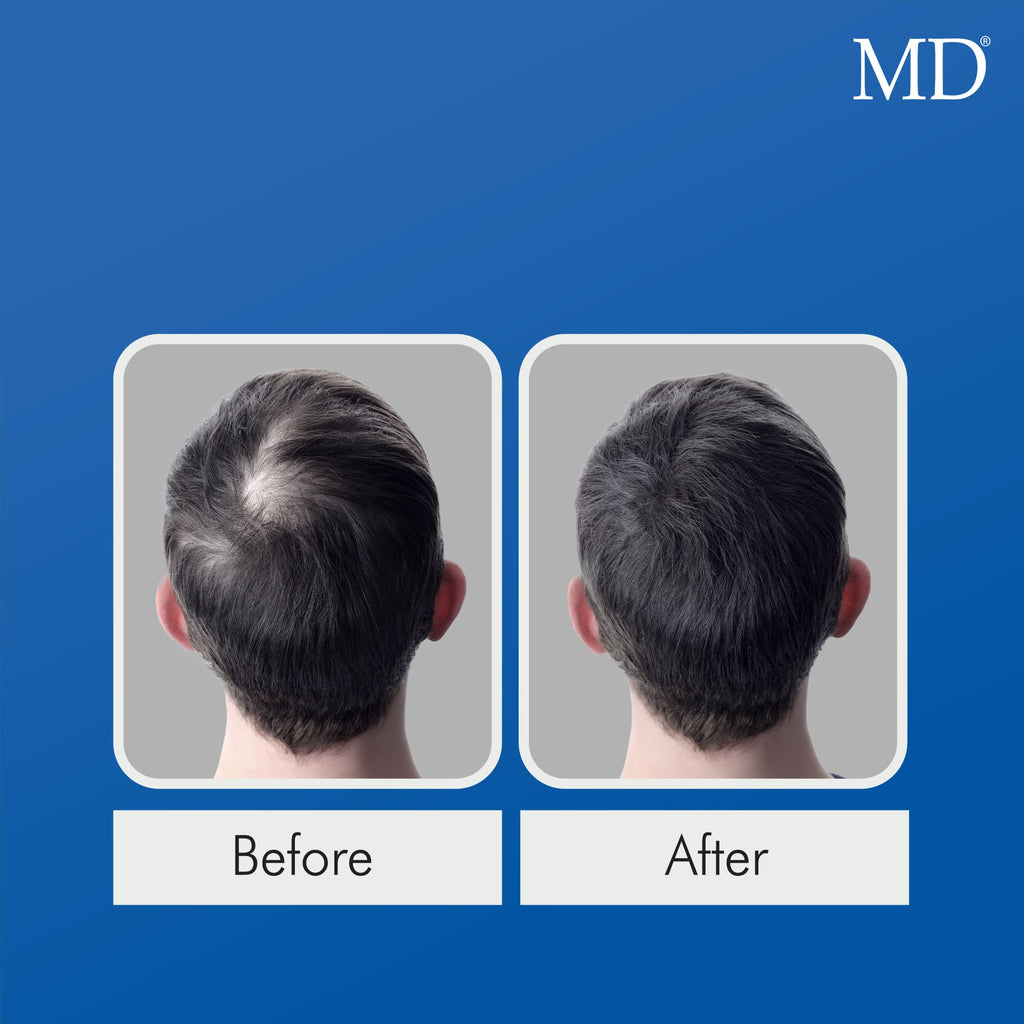 Male model before and after using MD Follicle Energizer hair growth serum showing visible hair regrowth and improved bald spot – MD Hair by MD