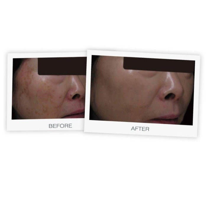Before and after using MD Brightening Cream showing reduced brown age spots and liver spots for clearer, brighter skin

