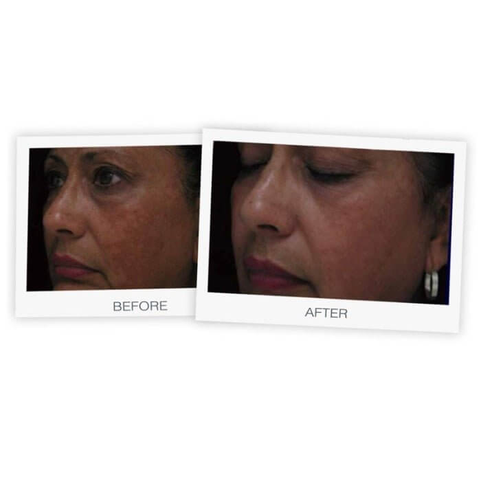 Before and after using MD Brightening Cream showing reduced melasma, dark circles, and brighter skin tone