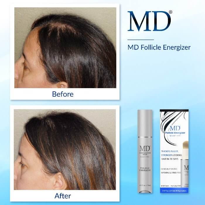 Before and after of female showing filled-in receding hairline and improved scalp coverage after using MD Hair serum