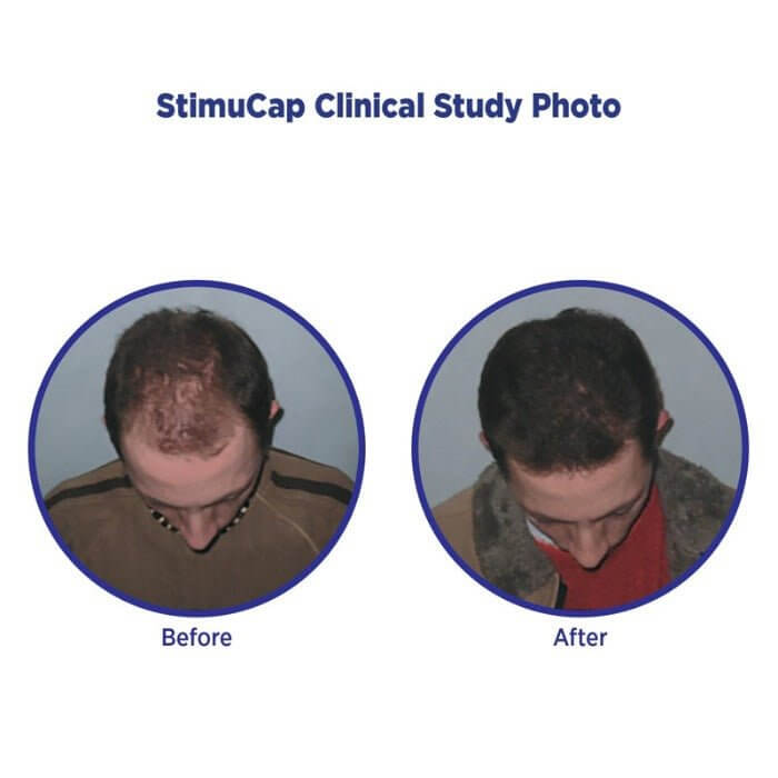 Before and after photo of male test subject using MD Revitalizing Conditioner by MD Hair. StimuCap® – showing visible restoration of scalp coverage and increased hair thickness after consistent use