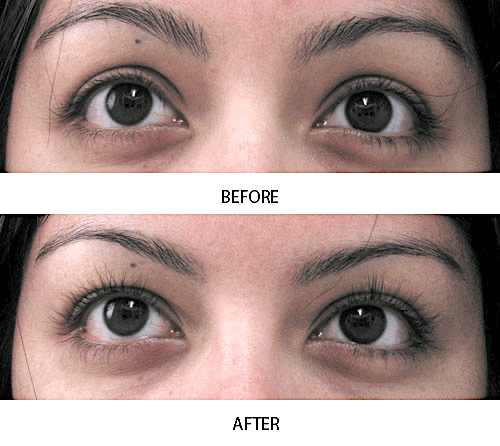 Before and after photo showing fuller, longer lashes after 4 weeks of using MD Lash Factor Eyelash Conditioner – real user result, no filters – lash serum by MD Lash