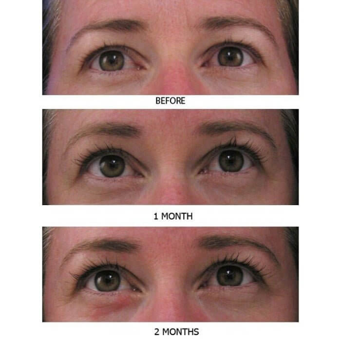 Before, 4-week, and 8-week progression photo of a middle-aged woman showing visibly longer, fuller, and thicker lashes with MD Lash Factor Eyelash Conditioner – lash growth serum by MD Lash