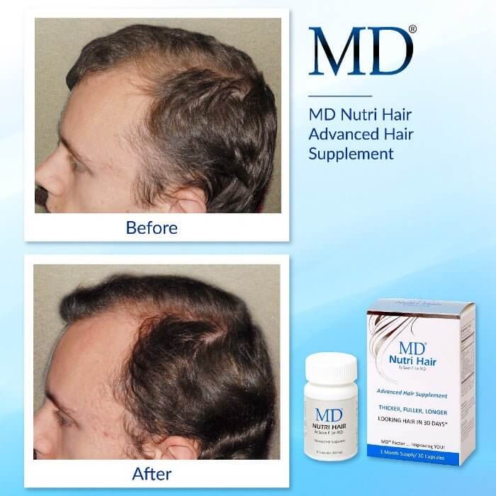 Before and after using MD Nutri Hair showing increased hair density, thickness, fullness, and a visibly healthier scalp.