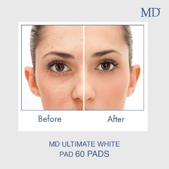 Before and after using MD Ultimate White Pad showing clearer, brighter, and more even skin tone with reduced pigmentation